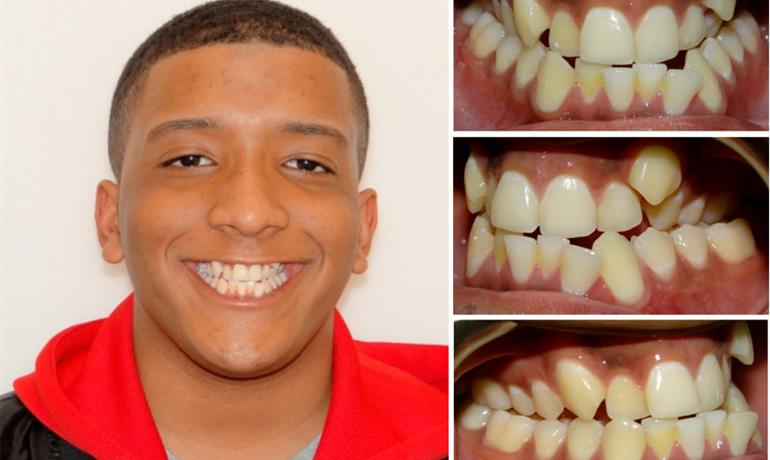 چگونگی درمان کراس بایت دندان